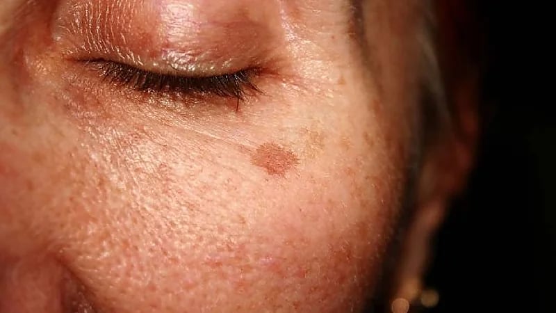 بقع الشيخوخة: أسبابها وطرق الوقاية والعلاج