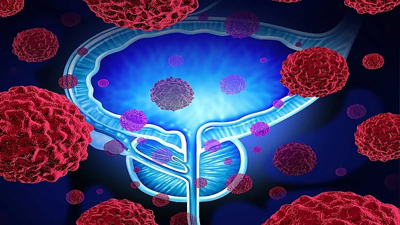 تطوير عقار لعلاج سرطان البروستاتا في مراحله المتقدمة