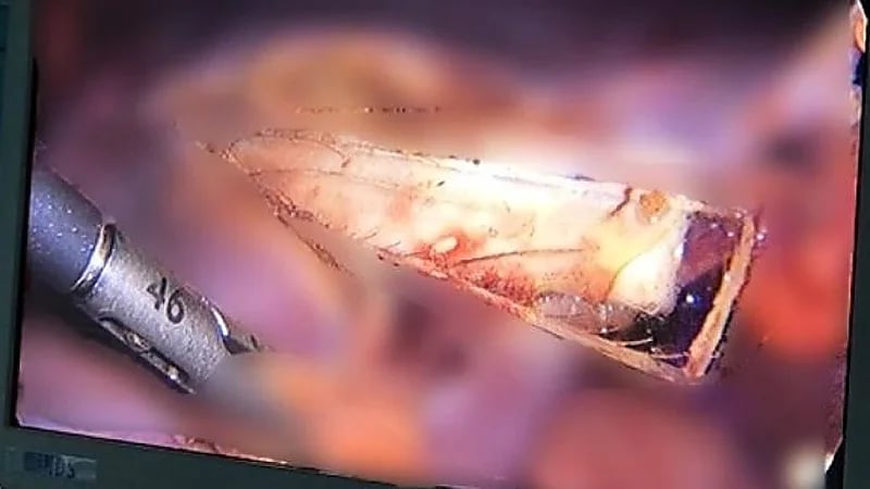 ‎شخص يكتشف وجود شظية زجاجية في كبده منذ 9 سنوات .. صور