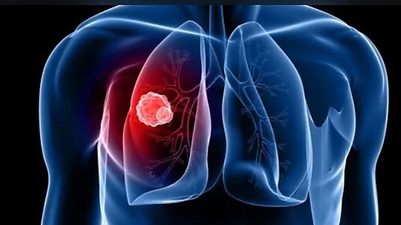 أبرز 6 أعراض مبكرة لسرطان الرئة