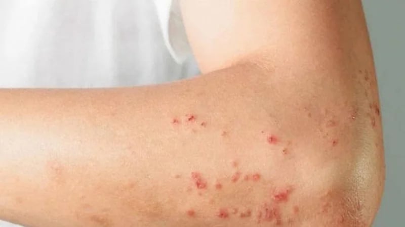 كندا تسجل 10 إصابات جديدة بجدري القرود