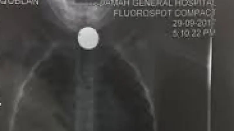 انقاذ حياة طفل ابتلع بطارية و14 قطعة لأجسام مختلفة توقفت بالمريء في نجران