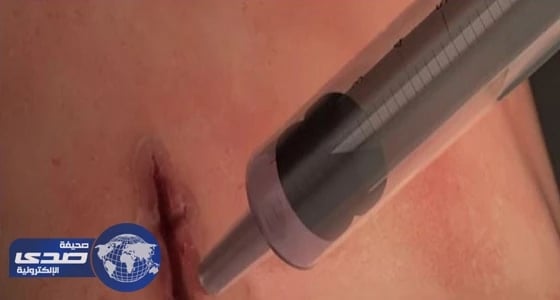 اكتشاف " غراء طبي " يغلق الجروح خلال ثوان