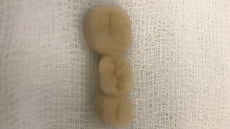 فريق طبي بمكة المكرمة ينقذ مواطنًا ابتلع طقم أسنان