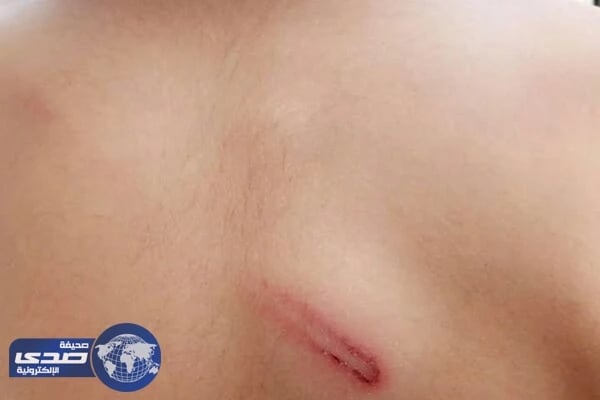 معلم يعتدي بوحشية على طالب بجازان