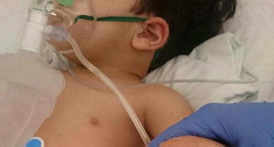 ماء النار ينهش لحم طفل عمره عامين في الأحساء