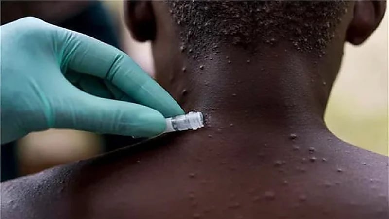 جدري القرود يصل السودان