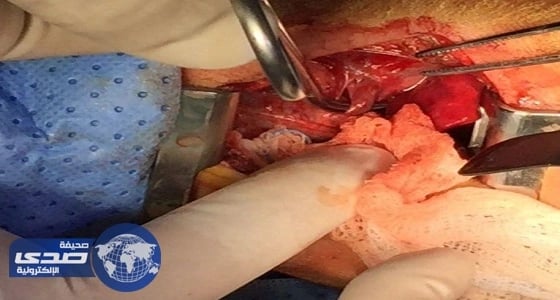 نجاح جراحة خطيرة لمولود بمستشفى الولادة والأطفال بالمدينة