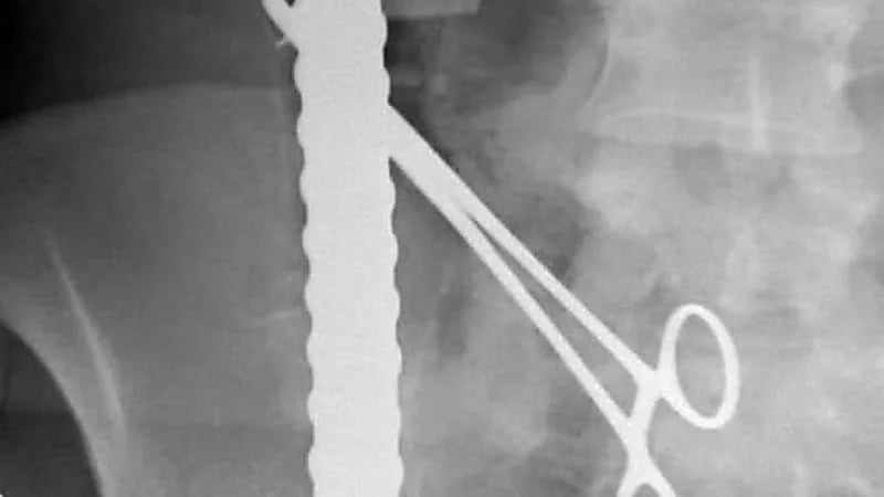 إنقاذ "مقيم" اخترق جسده 3 أسياخ حديدية