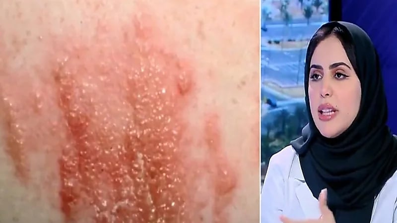 "استشارية": بعض أنواع المسكنات قد تسبب طفح جلدي