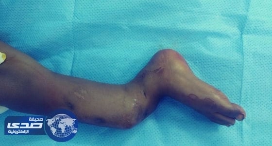 بالصور.. " صحة الباحة " تنجح في إعادة المشي لـ " طفل "