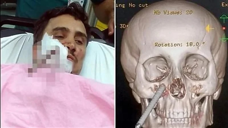 نجاة عامل بناء بأعجوبة بعد سقوطه على "سيخ حديدي"