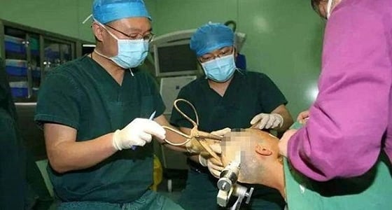 بالفيديو.. مقص يخترق جمجمة سيدة