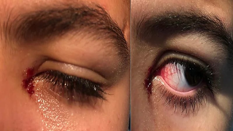 "الملك خالد" للعيون : 4 إصابات بسبب الألعاب النارية خلال العيد