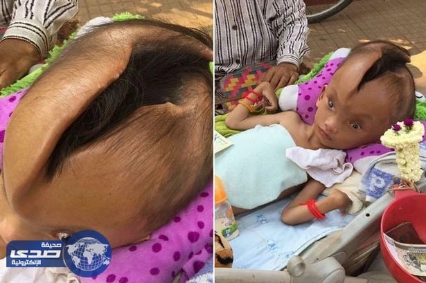 بالفيديو..شق عميق بجمجمة طفل يثير حيرة الأطباء