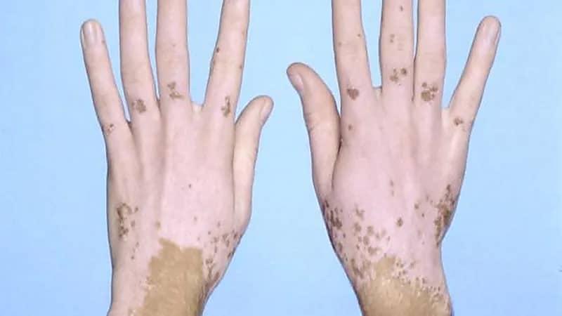 بالفيديو.. استشاري يكشف عن آخر الأساليب الطبية لعلاج "البرص والبهاق"