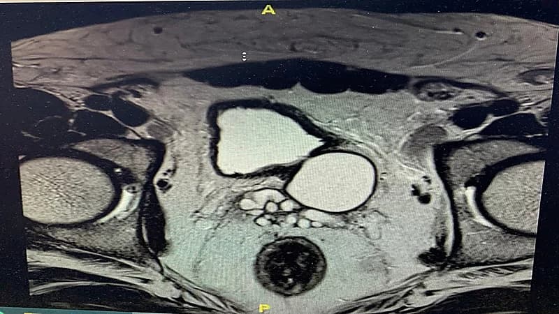 تسجيل اول حالة "لمتلازمة زينر الثلاثية" في مكة
