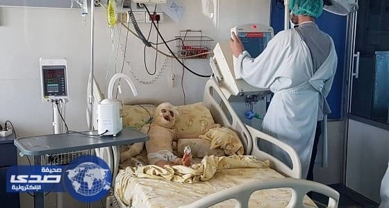 بالفيديو.. طفلة تسقط في وعاء زيت مغلي