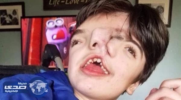 طفل بوجهين يُثبت خطأ الأطباء وتوقعاتهم بوفاته
