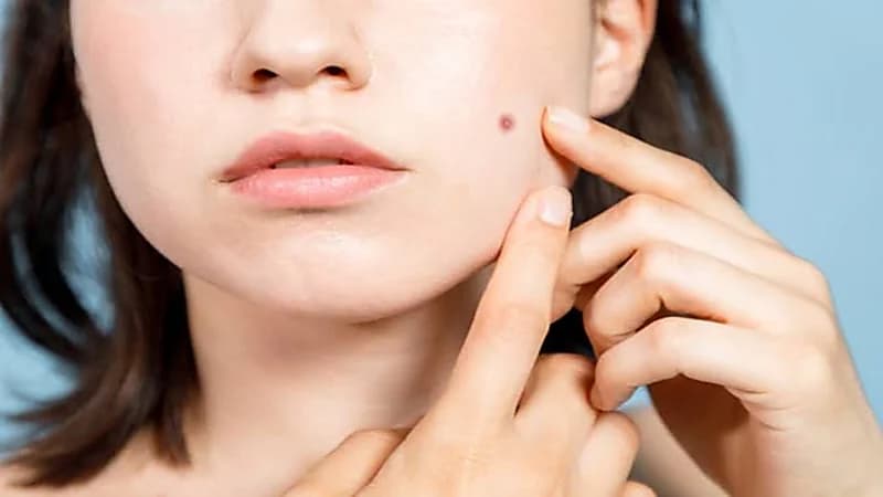 طرق العناية بالبشرة بعد إزالة الشامة