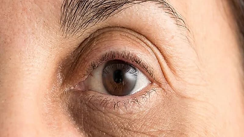 أسباب ظهور الهالات السوداء وكيفية العلاج