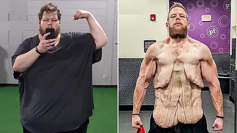 صورة صادمة لأمريكي خسر 152 كجم من وزنه