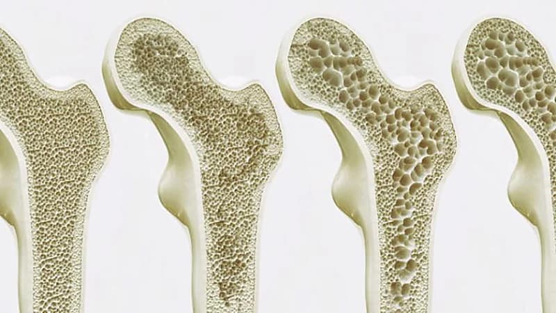 تلوث الهواء يسرع هشاشة العظام وإصابات العمود الفقري