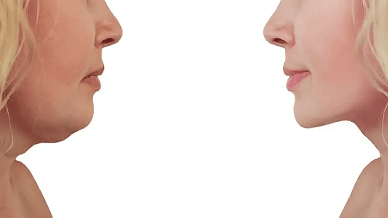 طرق بسيطة للتخلص من دهون الرقبة