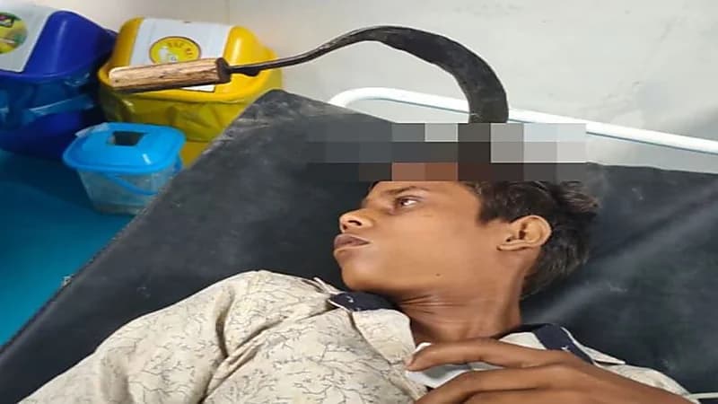 أطباء ينقذون حياة شاب بعد إزالة "محشّ" من رأسه "صور"