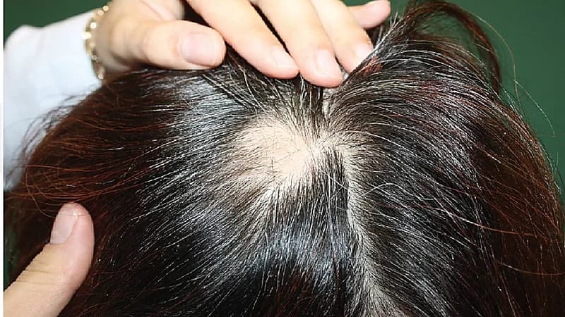 استشاري: احذروا استخدام الثوم في علاج الثعلبة .. فيديو