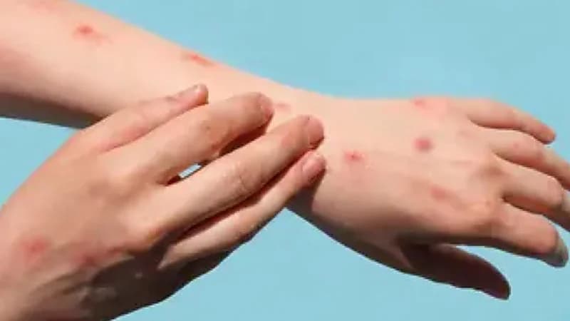 الصحة العالمية تعلن عن أول لقاح معتمد ضد جدري القردة