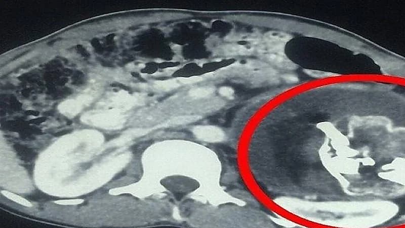 أطباء يستخرجون جنين طفيلي من بطن رضيع