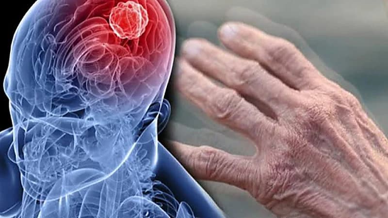 علماء بريطانيون يطورون اختبارًا يتنبأ بباركنسون عبر الجلد