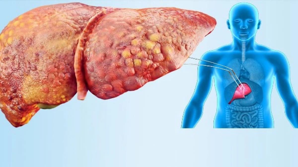 5 علامات تنذر بإصابتك بالكبد الدهني