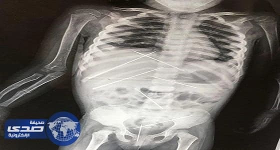 بالصور.. مسن هندي يغرس 7 إبر بجسد طفلة لمعالجتها من السحر الأسود