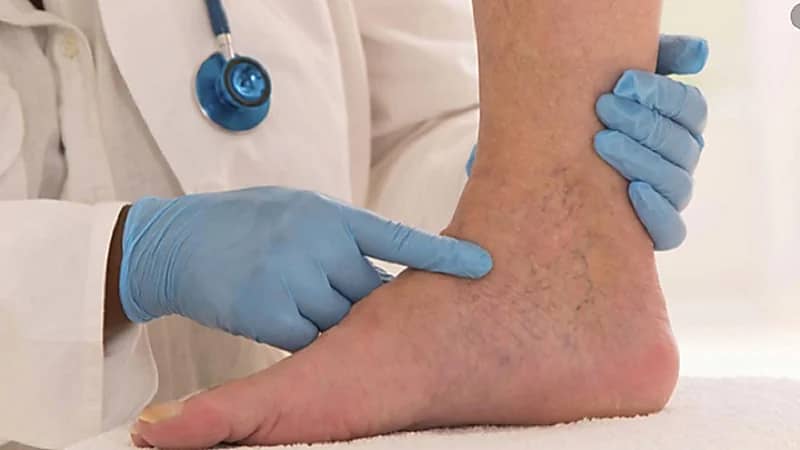 علامات على القدمين تشير إلى خطر الإصابة بمرض الكبد الدهني